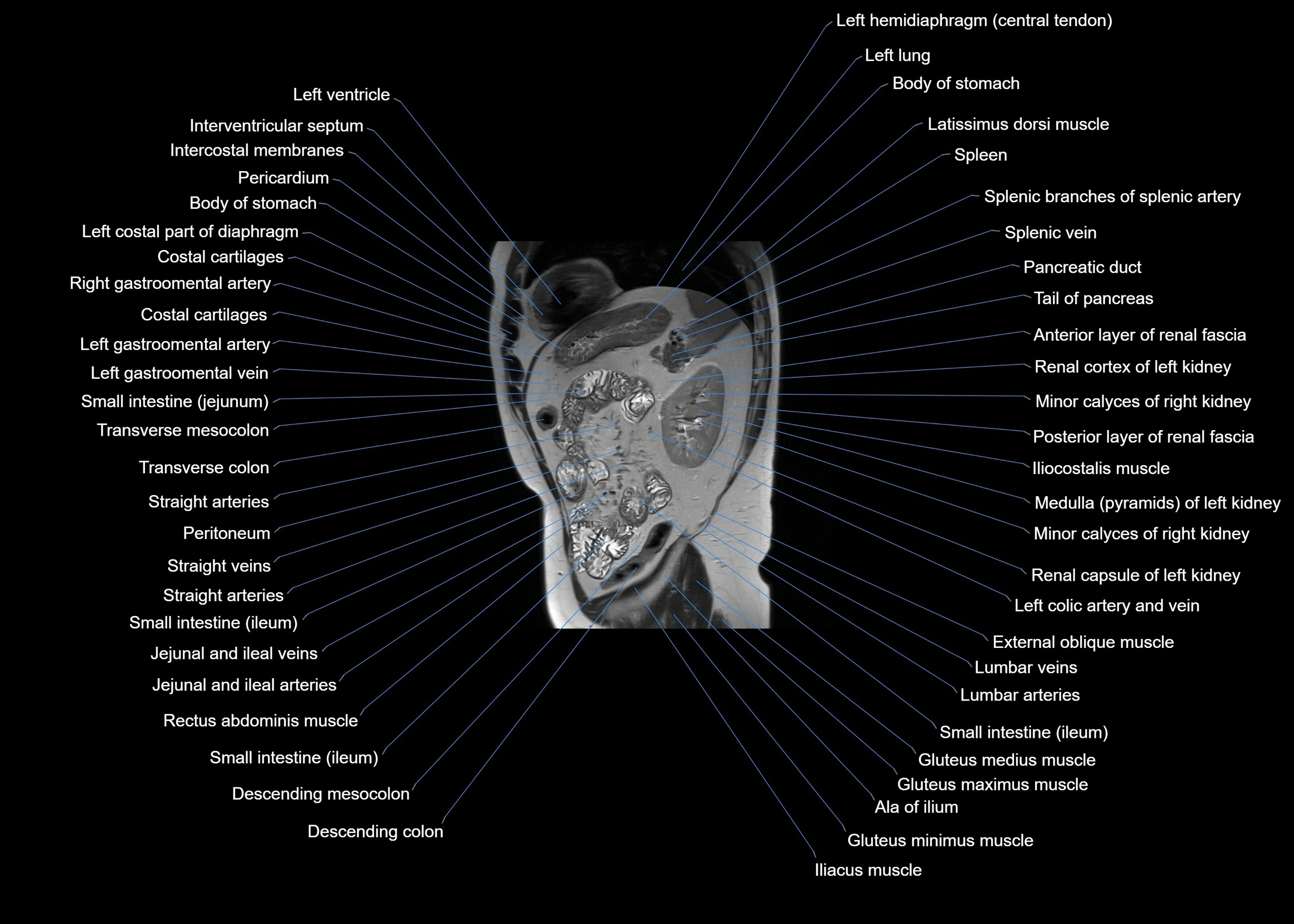 MRI abdomen sagittal cross sectional anatomy  radiology  image-img-00001-00052.webp